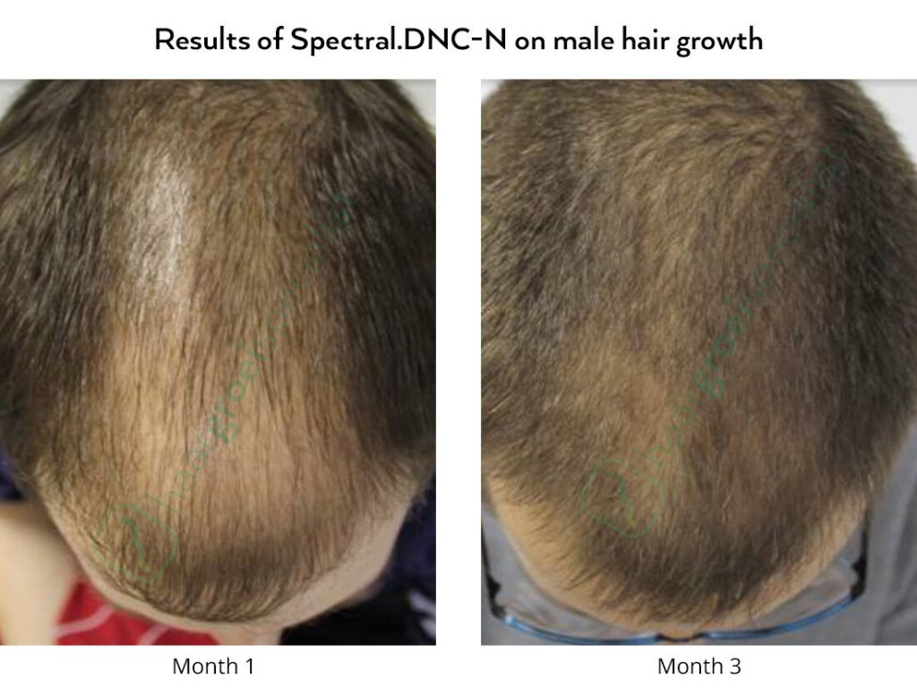 Fotos de antes y después, caída del cabello en hombres con loción Spectral.DNC-N Nanoxidil