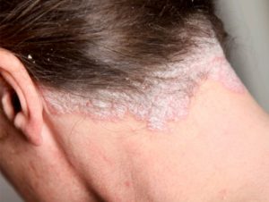 foto con psoriasis en el cuero cabelludo
