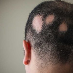 Alopecia areata causas
